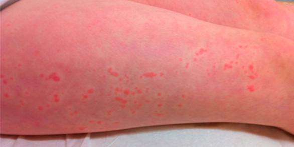 Patient with SJIA rash.